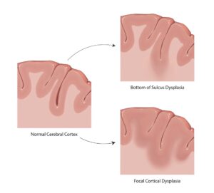 Illustration comparing a normal cerebral cortex to two types of cortical malformations. The left panel shows the normal brain surface with smooth folds. The upper right panel shows “Bottom of Sulcus Dysplasia,” where abnormal tissue is located deep in the groove of a brain fold. The lower right panel shows “Focal Cortical Dysplasia,” where the abnormal area affects a larger portion of the cortex. Arrows point from the normal cortex to each dysplasia type, showing where the abnormalities occur.