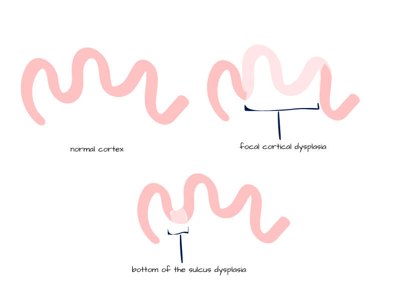 GPH cortical dysplasia Simple diagram showing three brain folds. One is labelled ‘normal cortex’ with smooth folds. The second is ‘focal cortical dysplasia,’ highlighting a thickened, abnormal fold. The third is ‘bottom-of-sulcus dysplasia,’ showing a small hidden lesion deep in a brain groove.